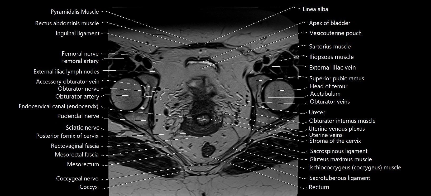 Axial cross sectional anatomy of female pelvis (MRI 3T) image 25.webp
